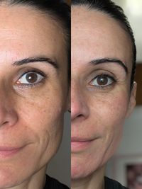Una sola sesión de Microneedling. Antes Vs Después Una sola sesión de Microneedling. Antes Vs Después